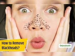 blackheads on the face here are the