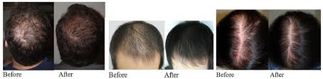 prp for hair loss stem cell hair