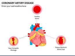 coronary artery disease powerpoint