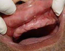numerous nodules on the upper lip