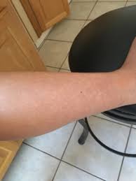 white spots on legs pic september