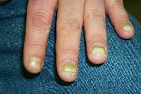 disfigured fingernails
