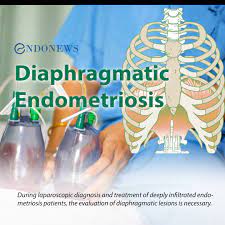 Thoracic endometriosis is the most common type of endometriosis outside of the pelvis. Diaphragmatic Endometriosis Endonews