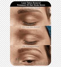 eyebrow tattoo removal permanent makeup