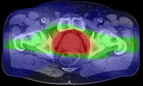 proton therapy for prostate cancer