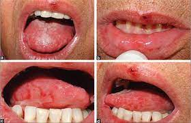 Cancer in cerul gurii simptome Tumorile benigne ale cavitatii orale si orofaringelui