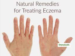 eczema home remedy treating eczema