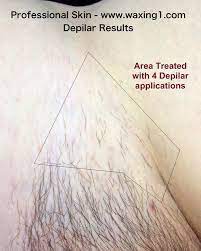 After a few sessions, it will only take around 30 minutes or less. Depilar Permanent Hair Reduction Proskin Brazilian Waxing Salon