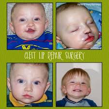 our cleft lip repair surgery journey