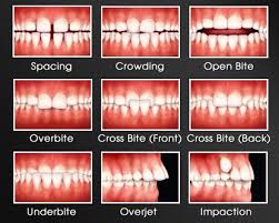 when to get an orthodontic consult