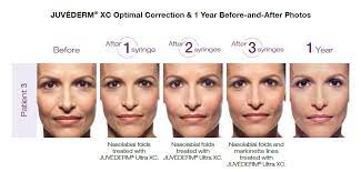 juvederm luxe dermatology