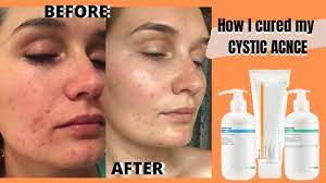 cystic acne acne org regimen