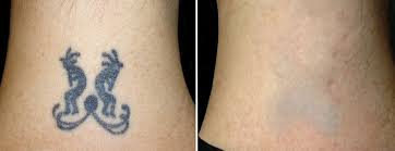 Tattoodo's informational guide this time introduces you to laser removal which is the most efficient way the best method for tattoo removal is laser removal. Tattoo Removal Twin Cities All Natural Non Laser Tattoo Removal