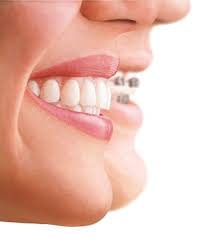 If the band gets under your gums, you can end up losing your tooth. Can Invisalign Fix Protruding Front Teeth