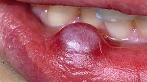 skin s on lips causes and treatment