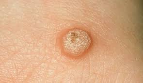 Image result for wart on face