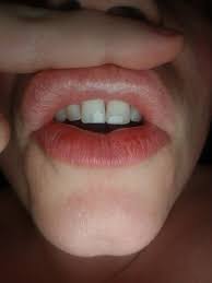 juvederm injected in my lips photo