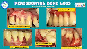 It is important to remove plaque and calculus to restore periodontal health. Dr Somit Jain On Twitter Periodontal Bone Loss Dentist Oralhealth Gumdisease Periodontology Dentistry Dental Periodontist Dentalhealth Dentalcare Https T Co Frqquf3rip Https T Co Ne7e9oqflh