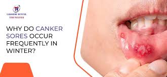 canker sores occur frequently in winter