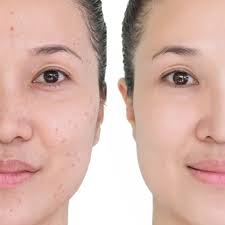 We have listed here 10 best products (cream, serum, and gel) for dark spots, acne scars, melasma, pigmentation, blemishes, wrinkles, age spots, etc. Effective Remedies Ways To Help Remove Dark Spots From The Skin Remedy You