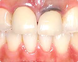 「メタルコアタトゥー　歯科」の画像検索結果