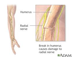 radial nerve dysfunction information