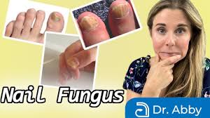 how to treat nail fungus naturally