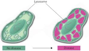 intersial lung disease in lysosomal