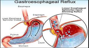 natural treatment of gastroesophageal