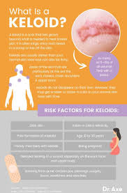 keloid causes symptoms and common