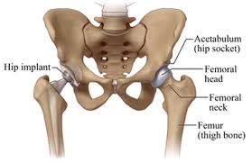 total hip replacement surgery basic guide