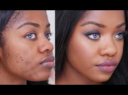 how to cover acne scars on dark skin