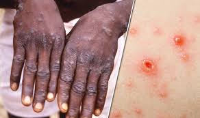 Symptoms begin with fever, headache, muscle pains, swollen lymph nodes, and feeling tired. Monkeypox Uk Virus In England How Deadly Infection Symptoms Are Similar To Chickenpox Express Co Uk