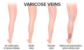 can spider veins come back after treatment