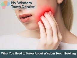wisdom tooth swelling