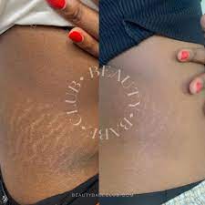 inkless stretch mark revision training