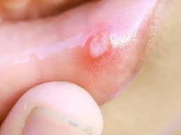 canker sore on tongue pictures causes