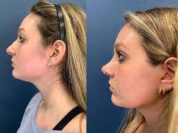 why rhinoplasty results look better