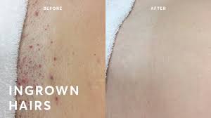 Professional hair removal services work. How To Get Rid Of Ingrown Hairs Forever Youtube