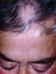alopecia areata guide causes symptoms