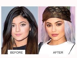 kylie jenner plastic surgery before