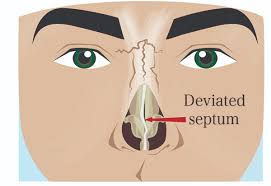 When a deviated septum is severe and not treated well, it can block one side of your nose and reduce airflow, causing difficulty breathing. Deviated Septum Treatment Septoplasty To Correct Deviated Septum