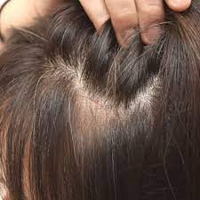 natural treatments for thinning hair