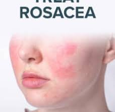 rosacea treatment 6 natural remes