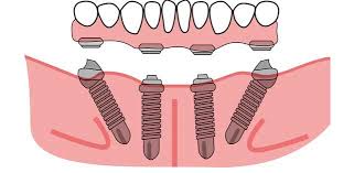 All on 4 Dental Implants The Solution to Long-Standing Dental Problems -  Grand Parkway Smiles