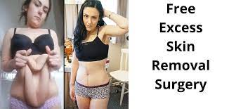 free excess skin removal surgery how