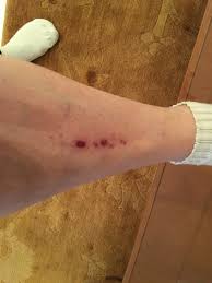 brush burn on my leg picture of monte