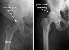 Image result for icd 10 cm code for right hip degenerative changes