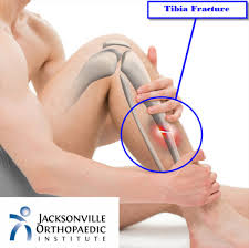 tibia and fibula fractures joi