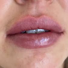 lip filler from 99 lip injections